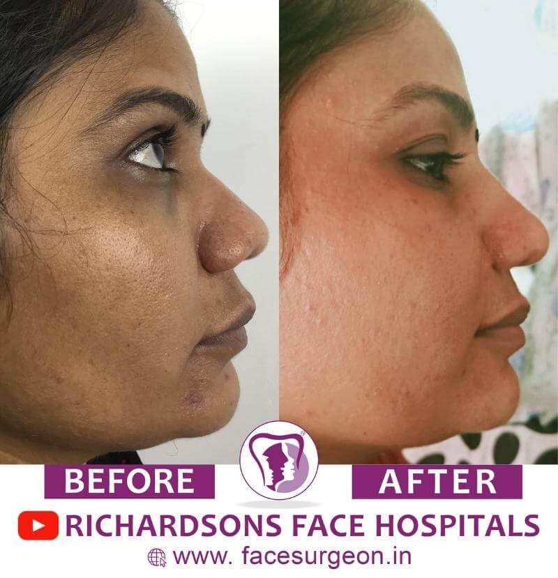 Before and After of Chin Surgery