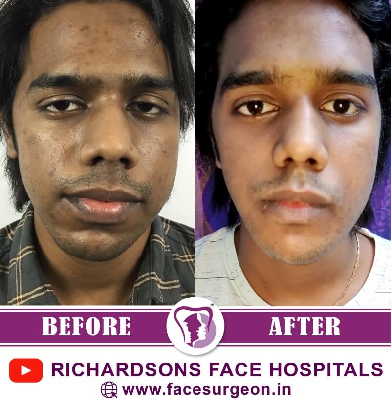 Before and After of Facial Asymmetry Surgery