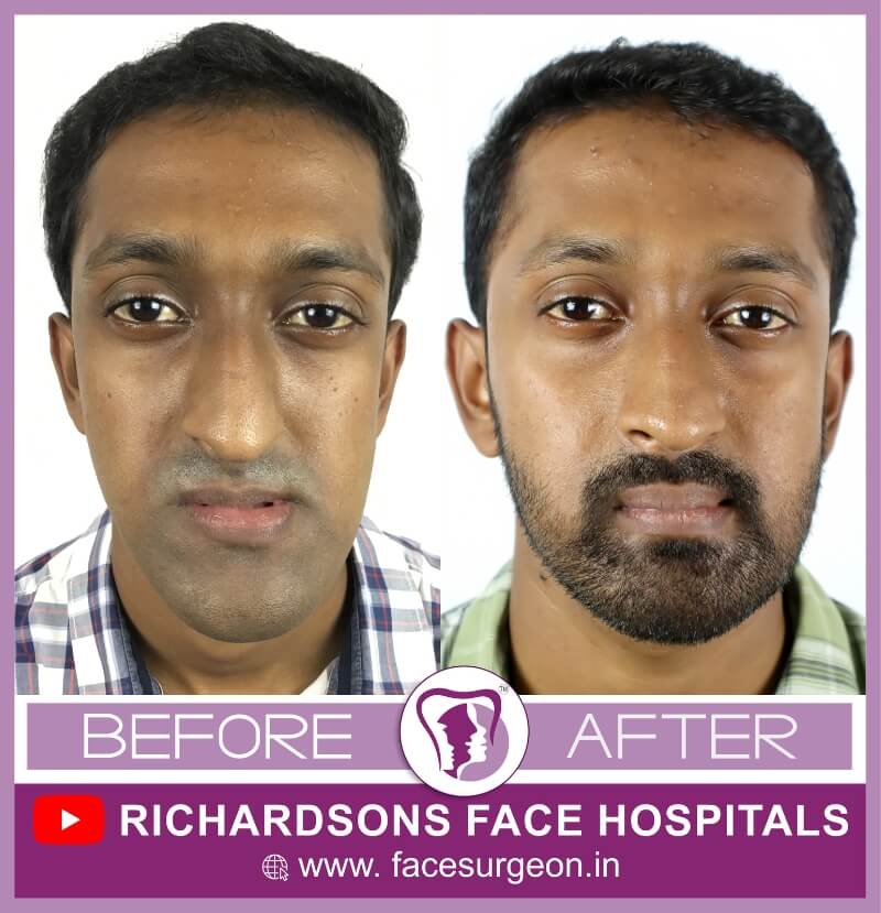 http://Before%20and%20After%20of%20Facial%20Asymmetry%20Treatment