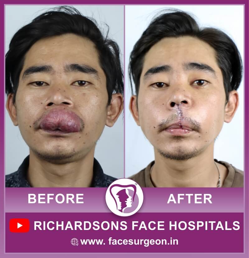 Before and After of Hemangioma Surgery