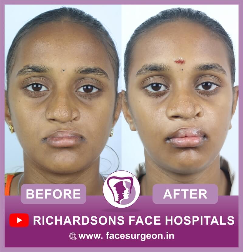 Before and After of Lip Revision Surgery