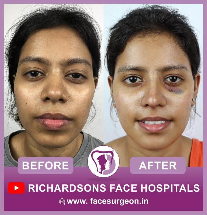 Before and After of Mentoplasty Surgery