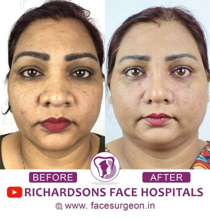Before and After of Nose Reshaping Surgery