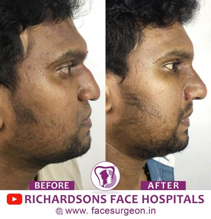 Before and After of Nose Surgery