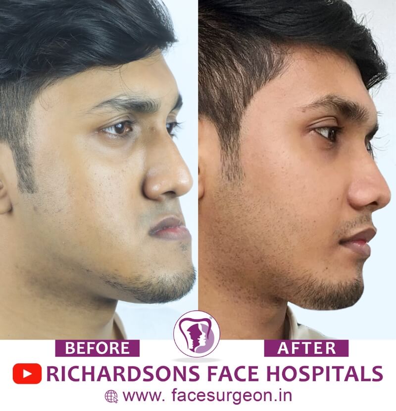 Before and After of Orthognathic Surgery