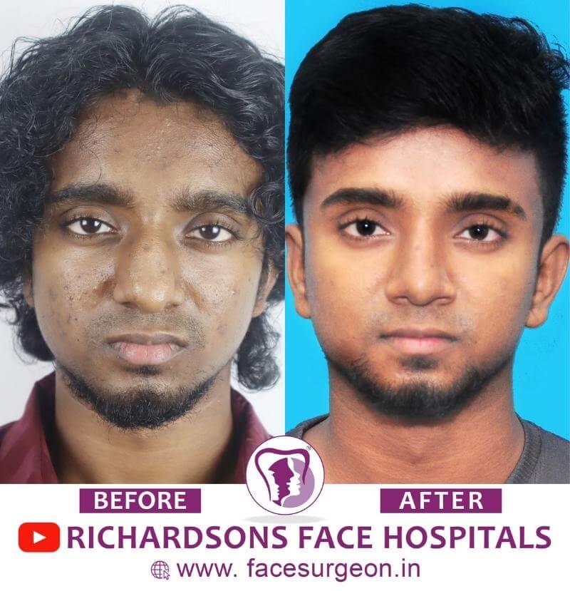 Before and After of Rhinoplasty Surgery