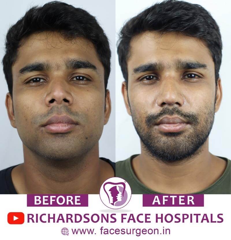 Before and After of Rhinoplasty Treatment