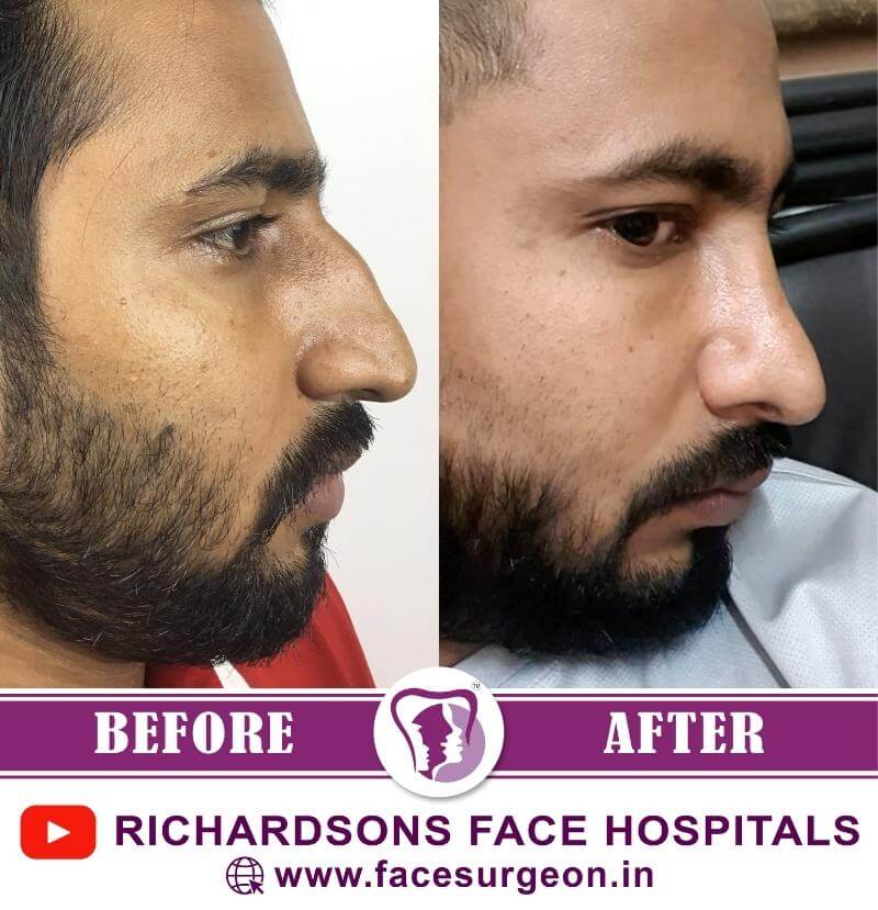 Before and After of Rhinoplasty