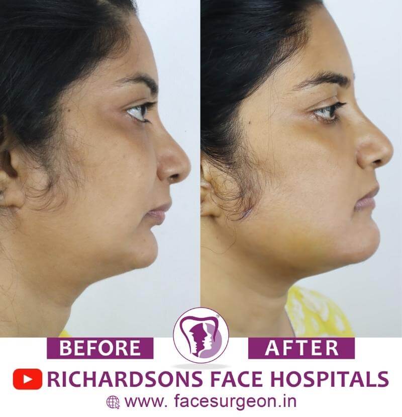 http://Chin%20Plastic%20Surgery%20Before%20After
