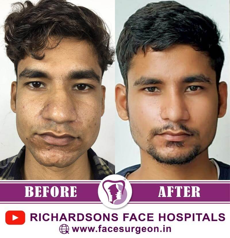http://Chin%20Plastic%20Surgery%20Before%20and%20After