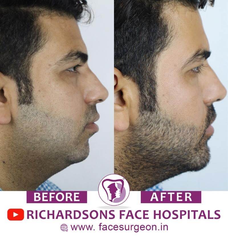 Chin Plastic Surgery Result