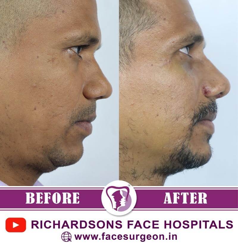 http://Chin%20Plastic%20Surgery%20Results