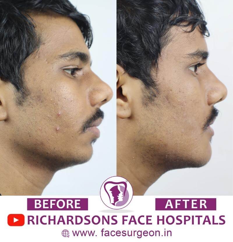 Chin Plastic Surgery Side View