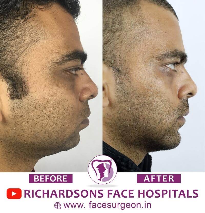 Chin Surgery Before After