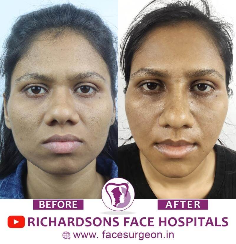 Chin Surgery Before and After Result
