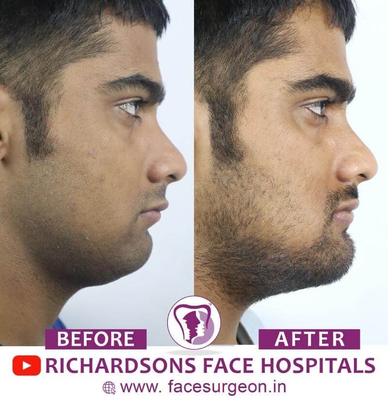 Chin Surgery Before and After Results