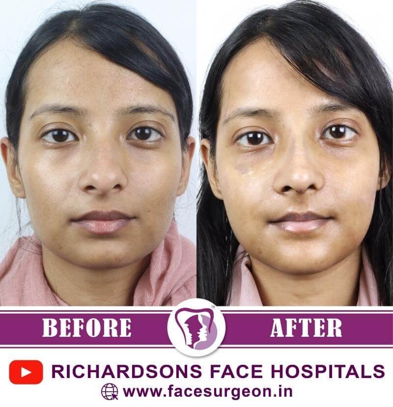 Chin Surgery Before and After