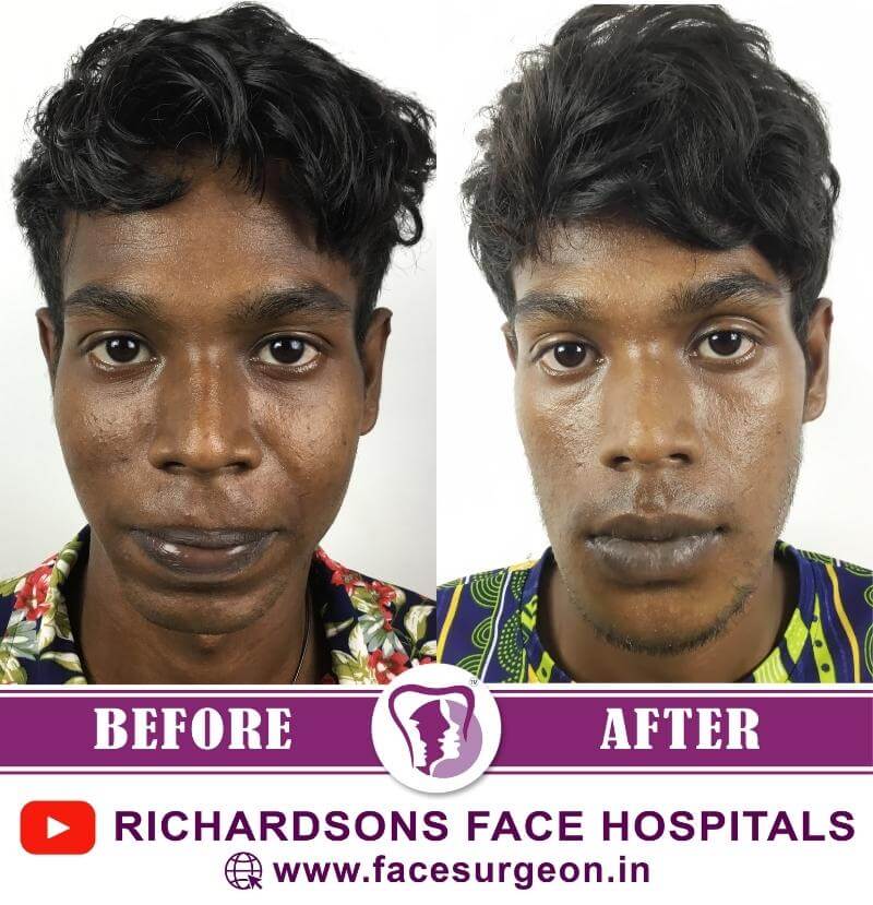 http://Chin%20Surgery%20Results