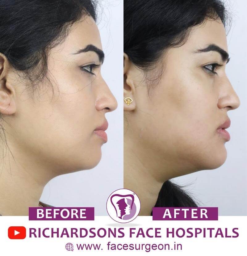 Chin Surgery Side View