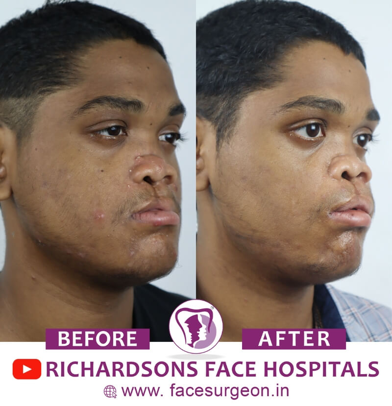 Cleft Lip Surgery Before After