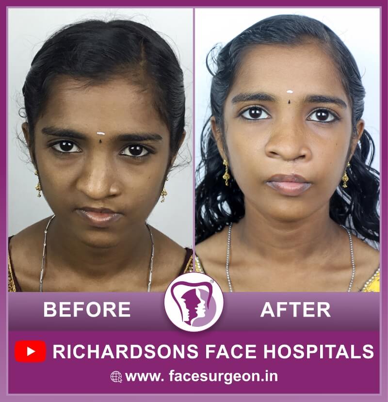 Cleft Lip Surgery Front View
