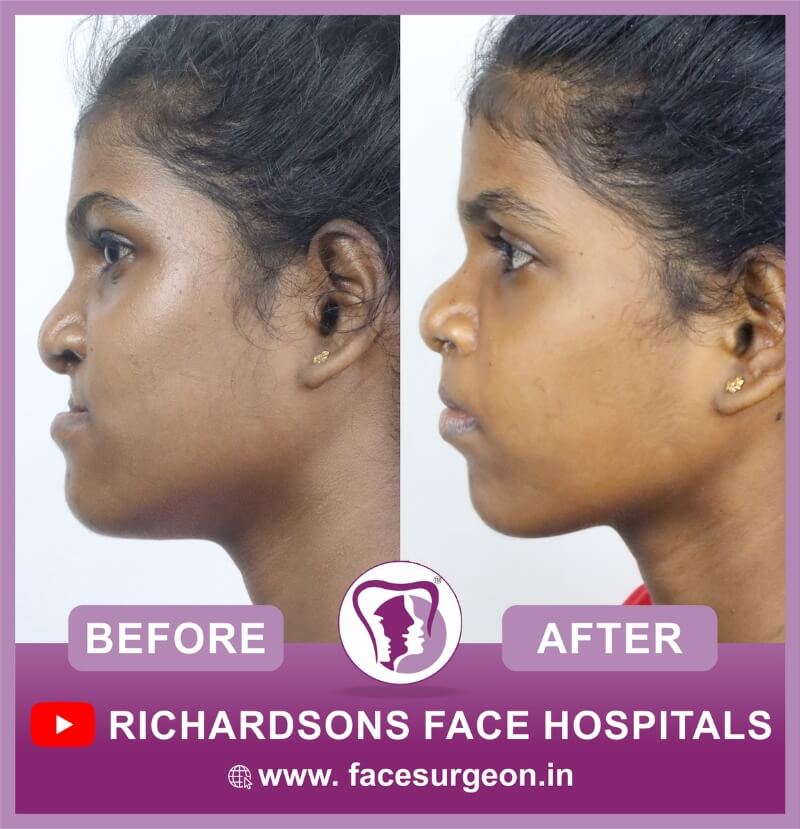Cleft Lip Surgery Side View
