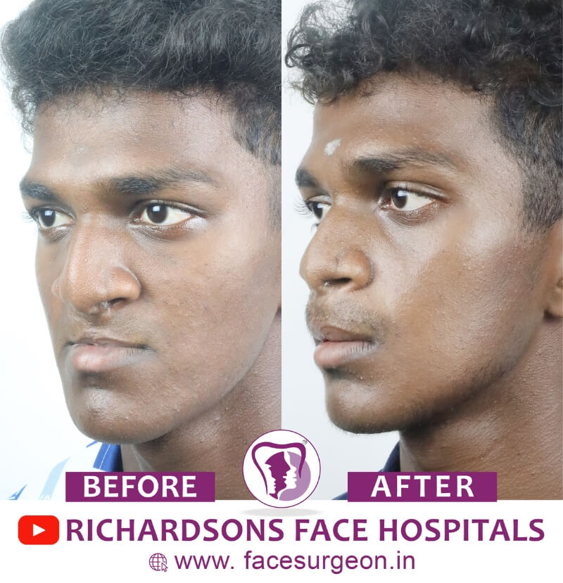 Cleft Lip Treatment Before After
