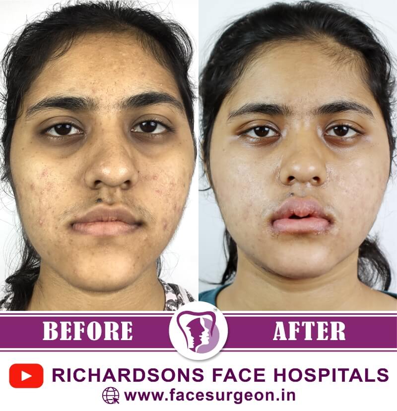 Corrective Jaw Surgery Before After