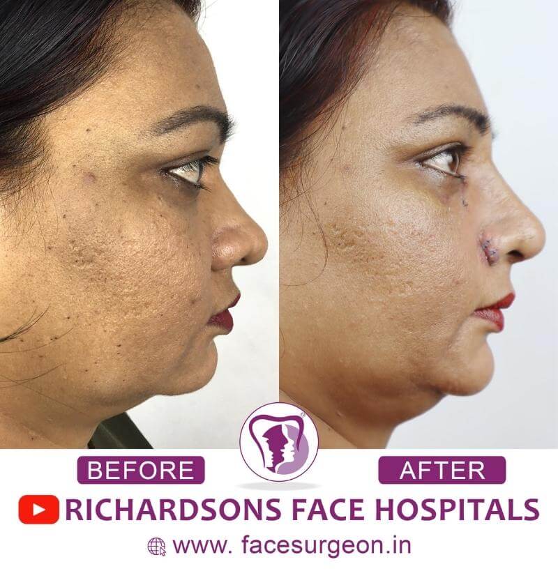 Cosmetic Nose Reshaping