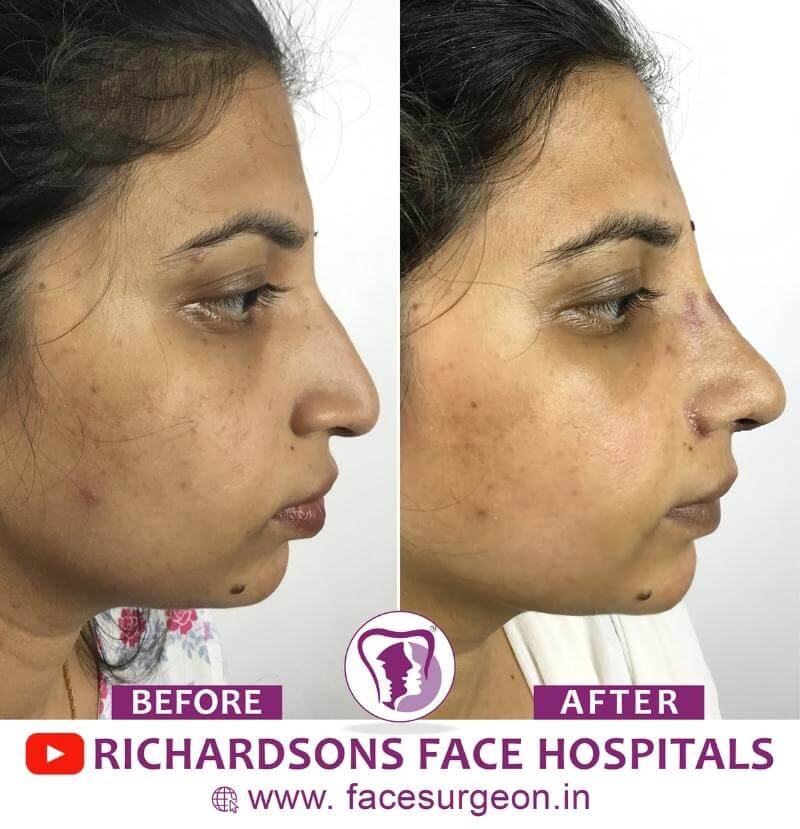 http://Cosmetic%20Nose%20Surgery