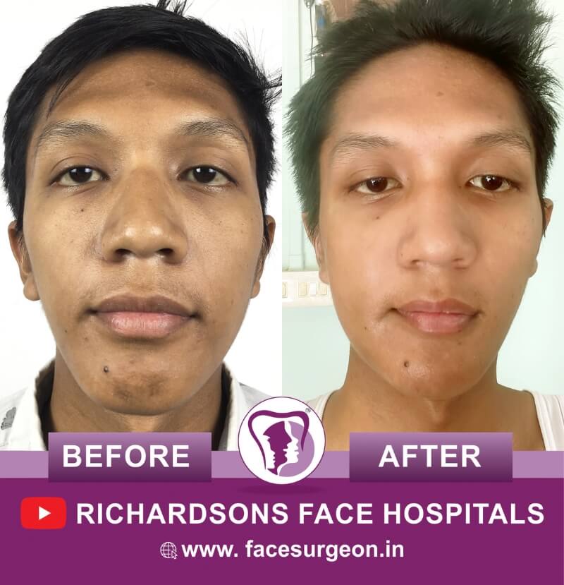 Facial Asymmetry Correction Surgery