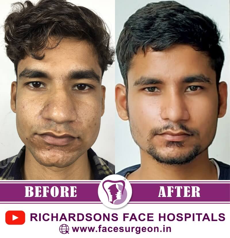 Facial Asymmetry Correction Treatment