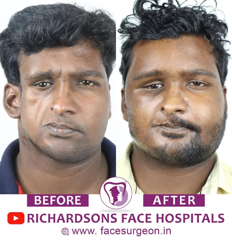 Facial Asymmetry Correction