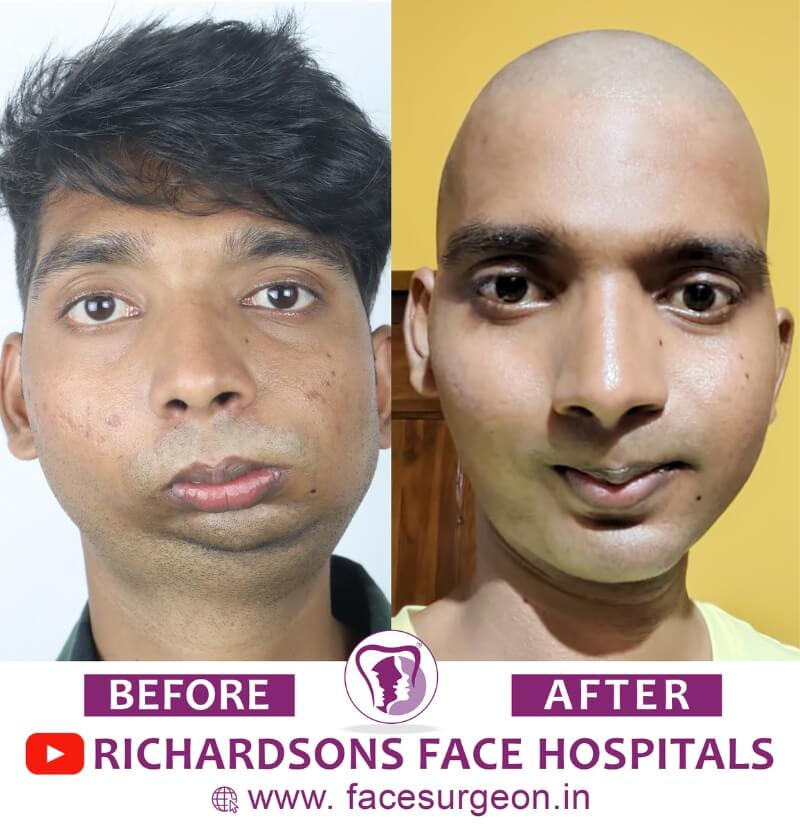 Facial Asymmetry Surgery Before After