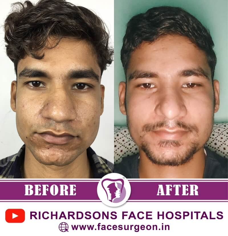Facial Asymmetry Surgery Front View