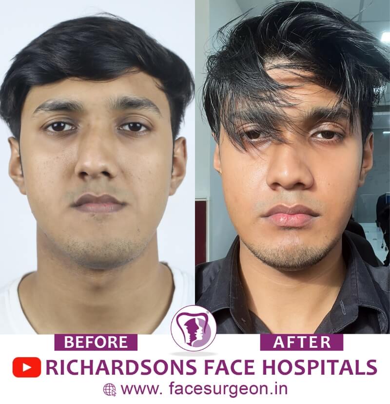 Facial Asymmetry Surgery Result