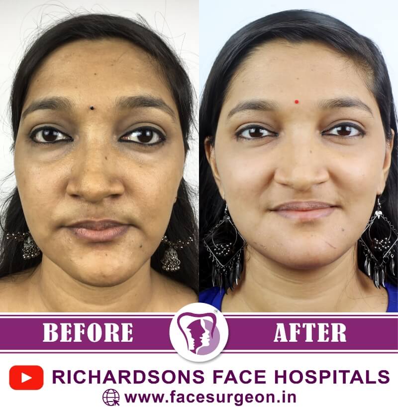 Facial Asymmetry Surgery Results