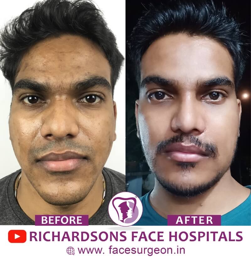 http://Facial%20Asymmetry%20Treatment%20Before%20After