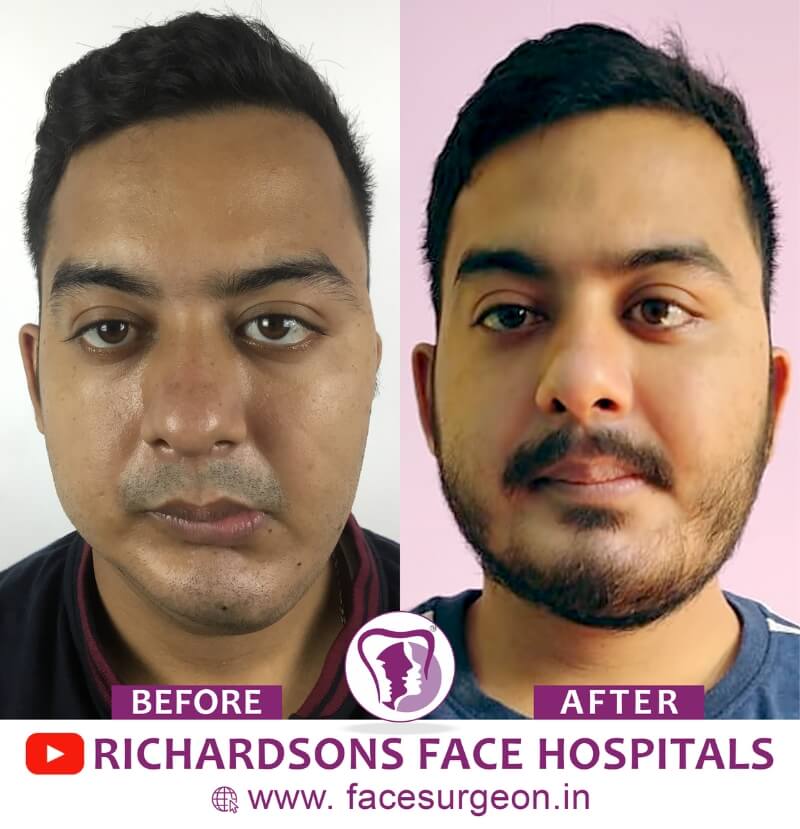 Facial Asymmetry Treatment Front View