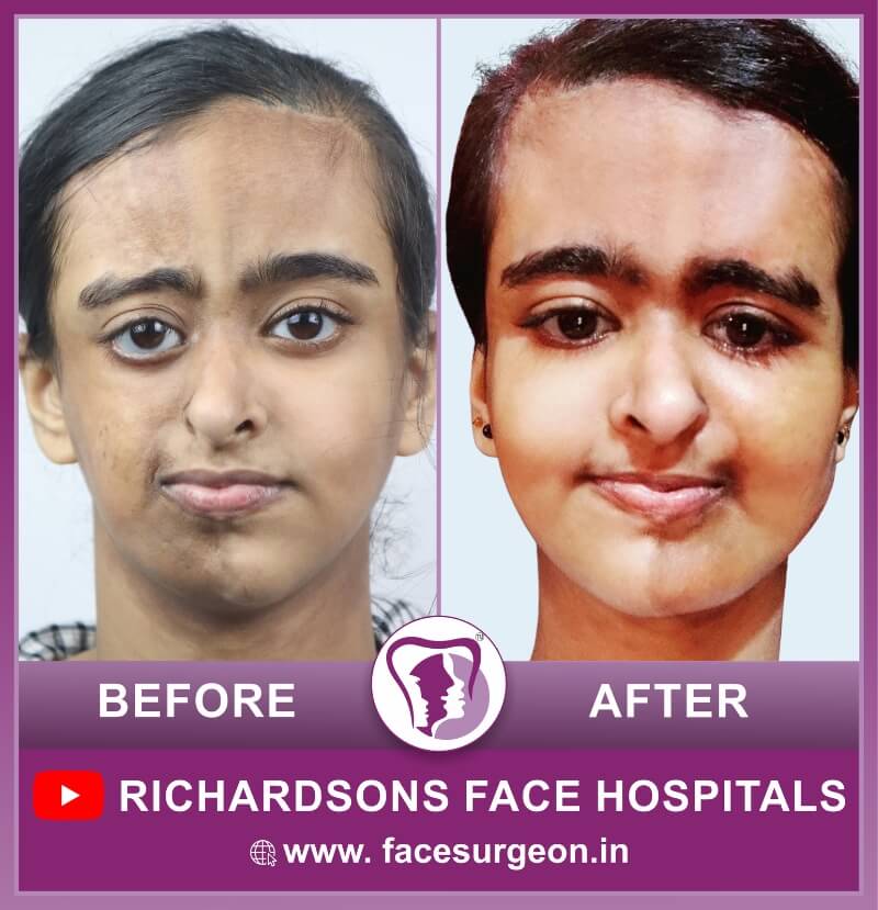 Facial Asymmetry Treatment