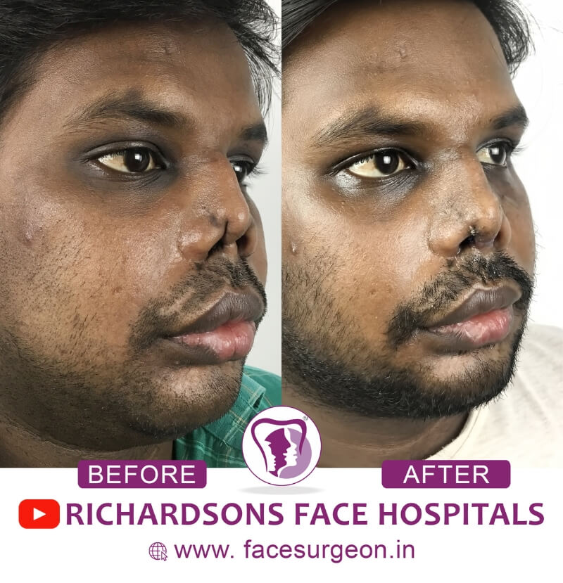 Facial Trauma Surgery Before After