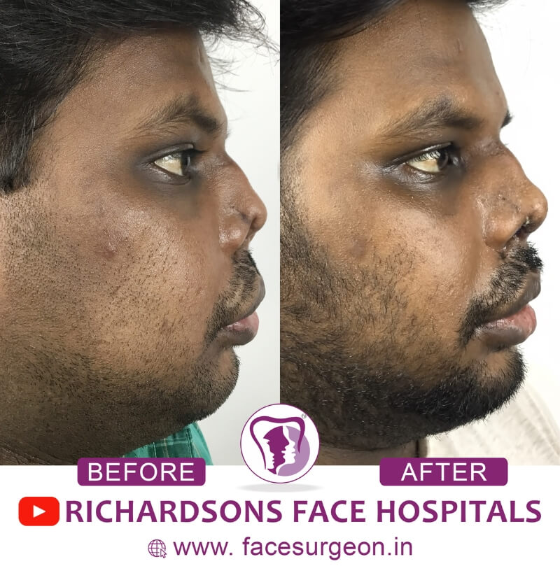 Facial Trauma Surgery Side View