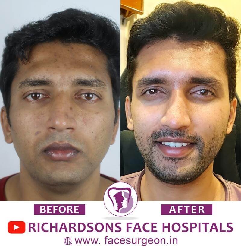 Front View of Chin Plastic Surgery