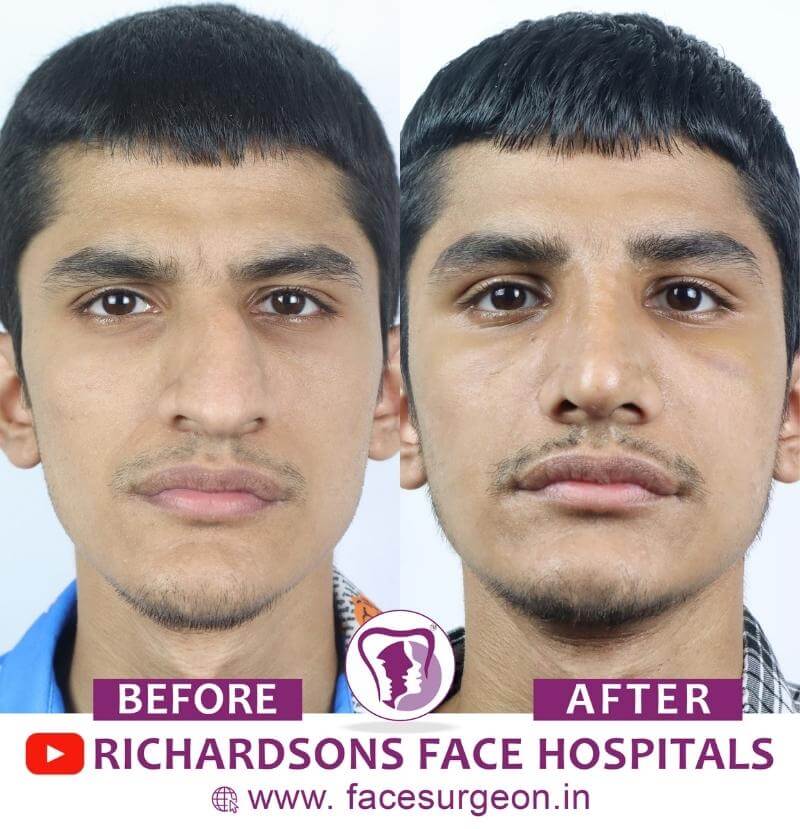 Front View of Rhinoplasty Surgery