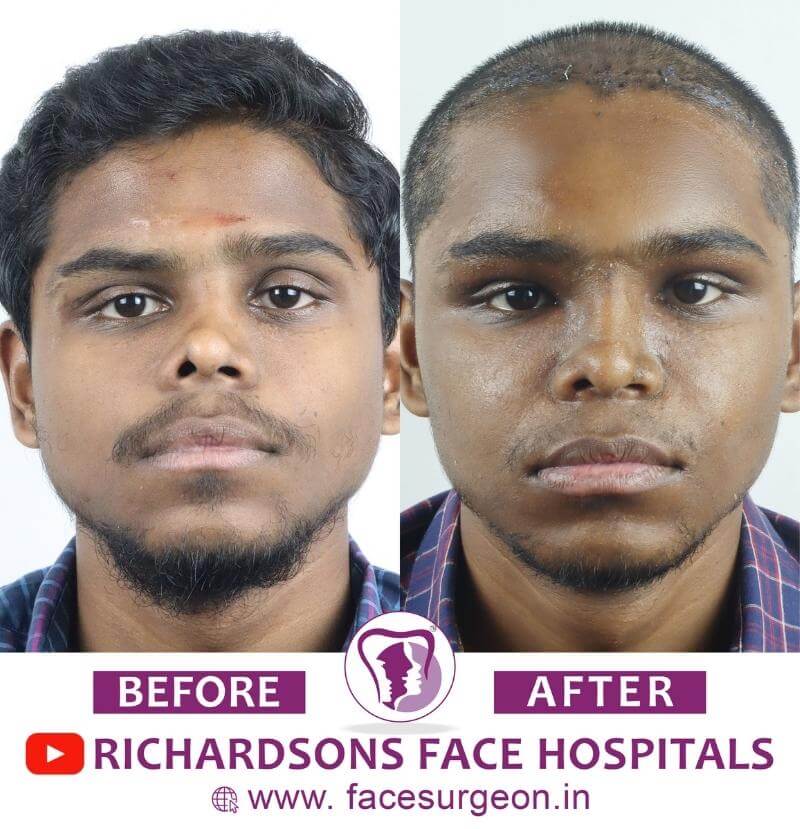 http://Front%20View%20of%20Rhinoplasty%20Treatment