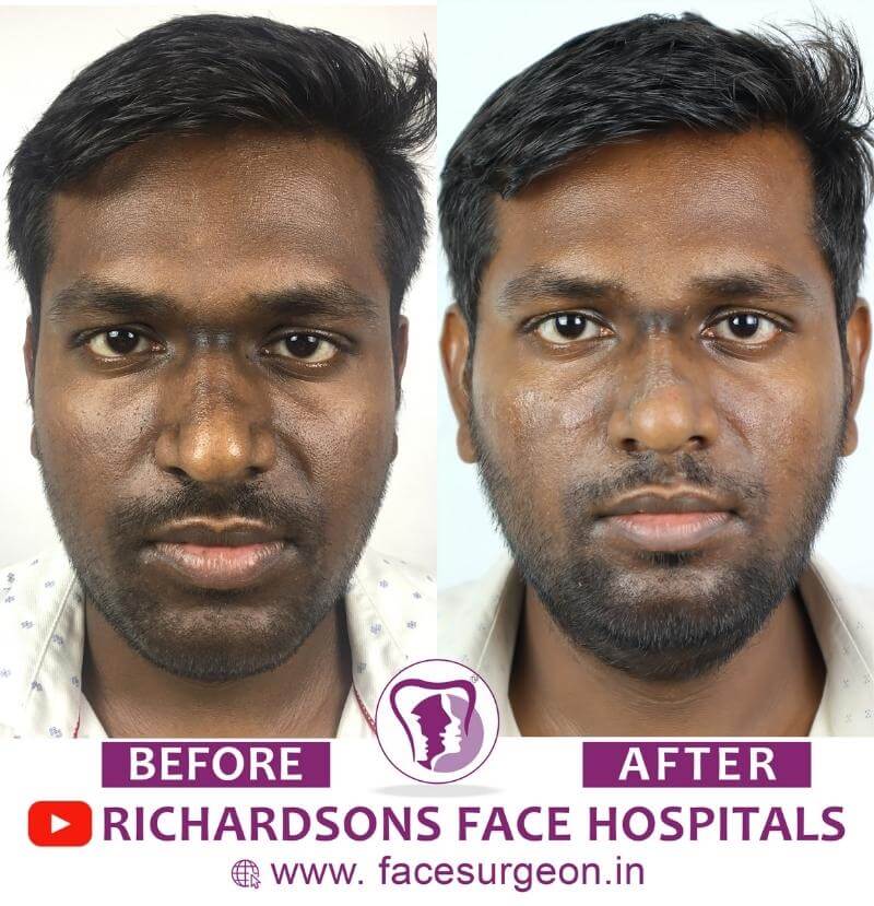 Front View of Rhinoplasty