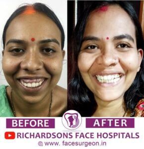 Gummy Smile Correction Before After
