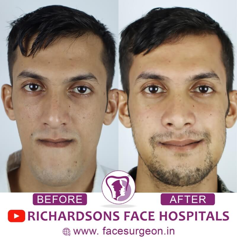 Jaw Surgery Results