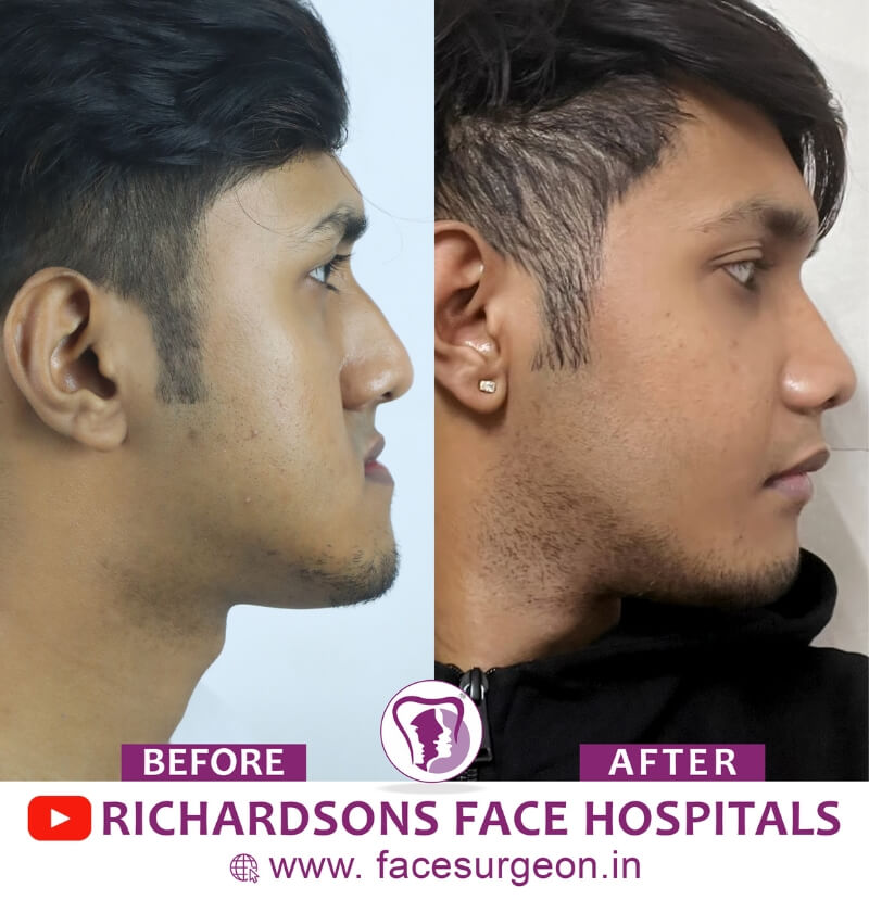 Jaw Surgery Side View