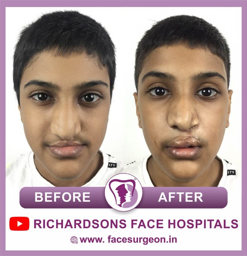 http://Lip%20Revision%20Surgery%20Result